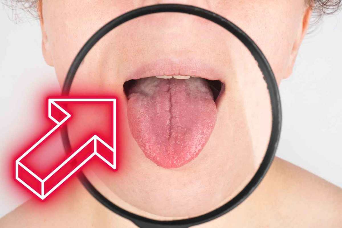 5 segnali dalla lingua che indicano malattie
